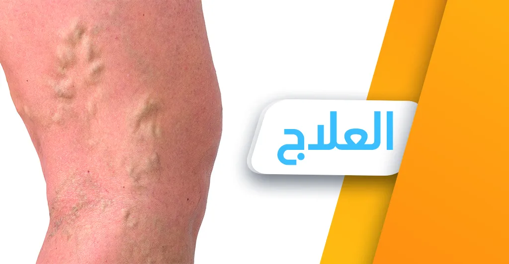 ماهو مرض الدّوالي وماهي أعراضه ؟